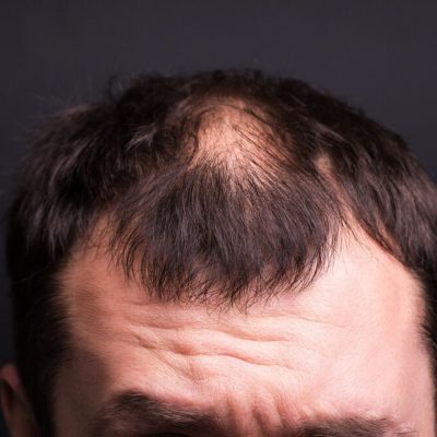 Alopecia Areata