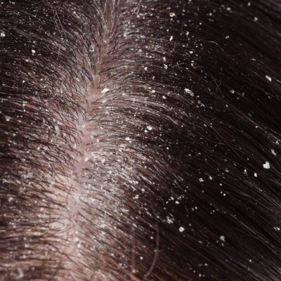 Dandruff