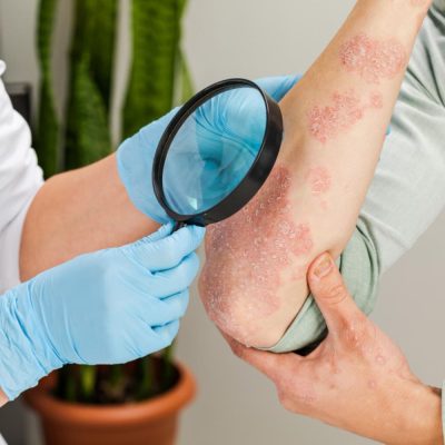 Dermatitis1