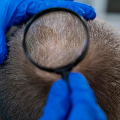 Diagnosis of Alopecia Areata