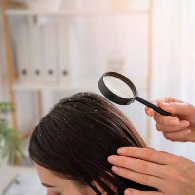 Diagnosis of Dandruff