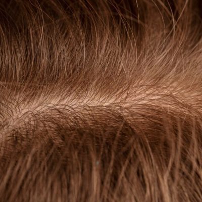 Diagnosis of Female Pattern Hair Loss