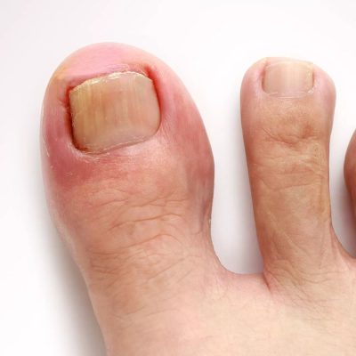 Diagnosis of Ingrown Toenail