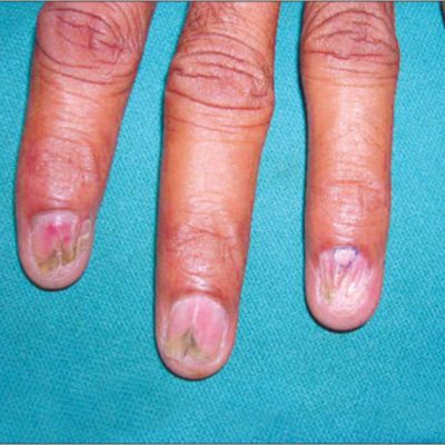 Diagnosis of Nail Lichen Planus
