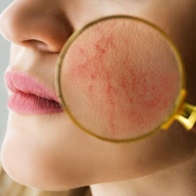 Diagnosis of Rosacea1