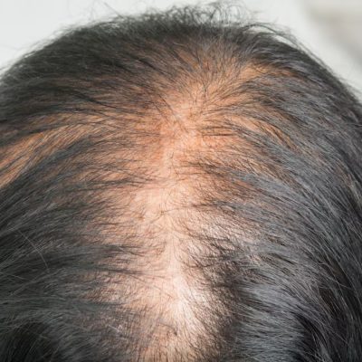 Diagnosis of Telogen Effluvium