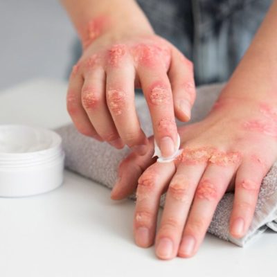 Eczema 1