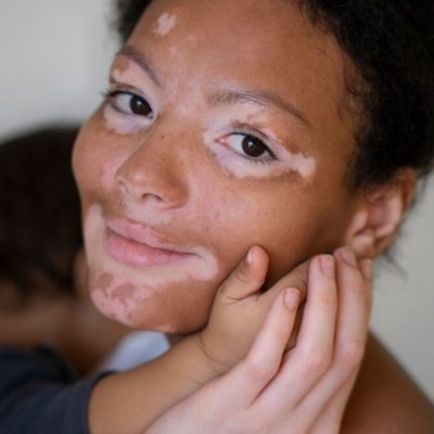 Excimer Laser for Vitiligo Repigmentation