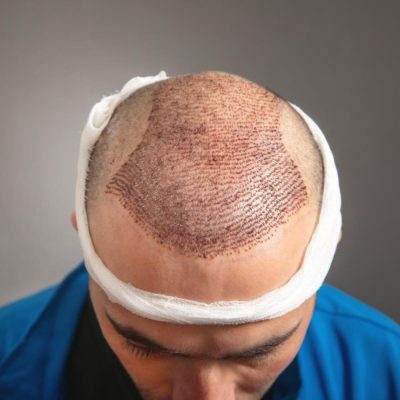 Hair Transplant