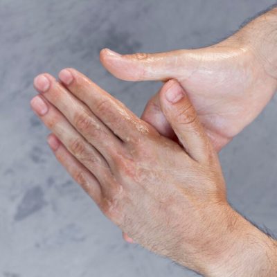 Hyperhidrosi