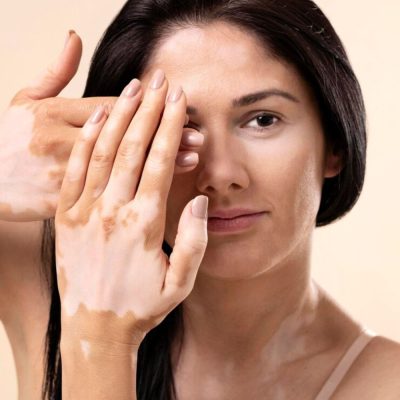 Hypopigmentation