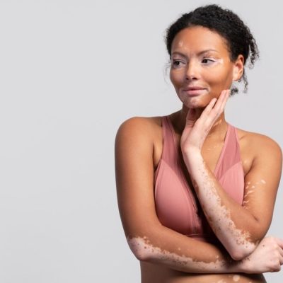 Hypopigmentation1