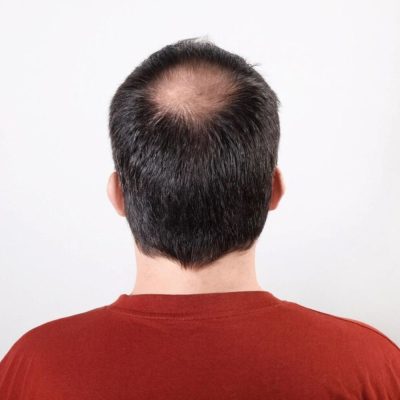 Male Pattern Hair Loss