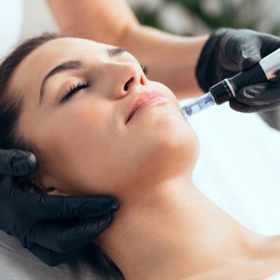 Microneedling Radio Frequency (MNRF)