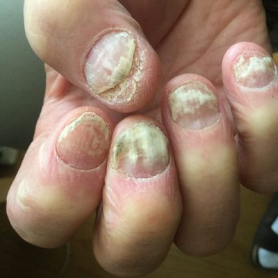 Nail Lichen Planus