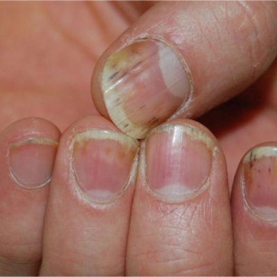 Nail Psoriasis
