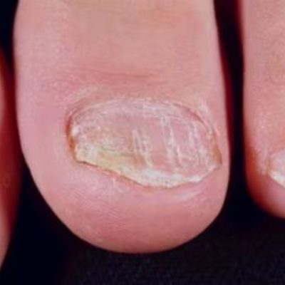 Nail Psoriasis