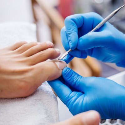 Onychomycosis