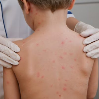 Paediatric Dermatology
