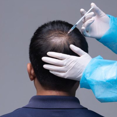 Platelet-Rich Plasma (PRP) Therapy for Hair Restoration