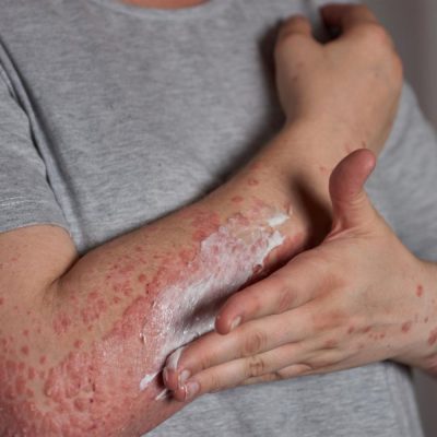 Psoriasis