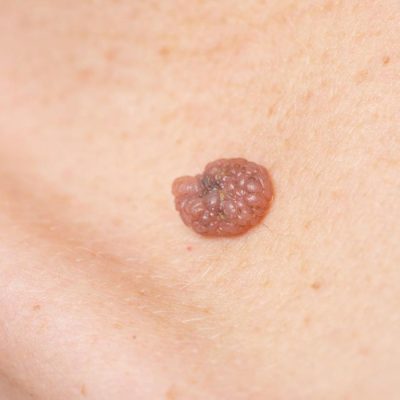 Skin Cancer(1)