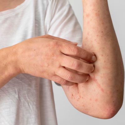 Skin Infections