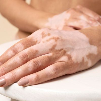 Vitiligo1