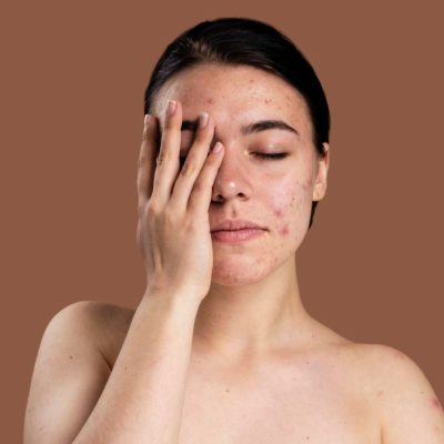 acne1
