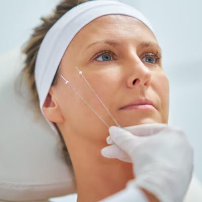 facial threadlift
