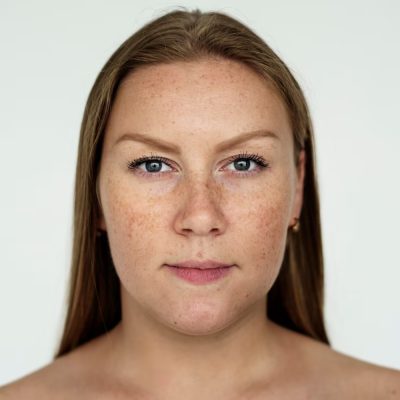 melasma