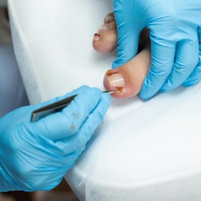 nail removal surgery